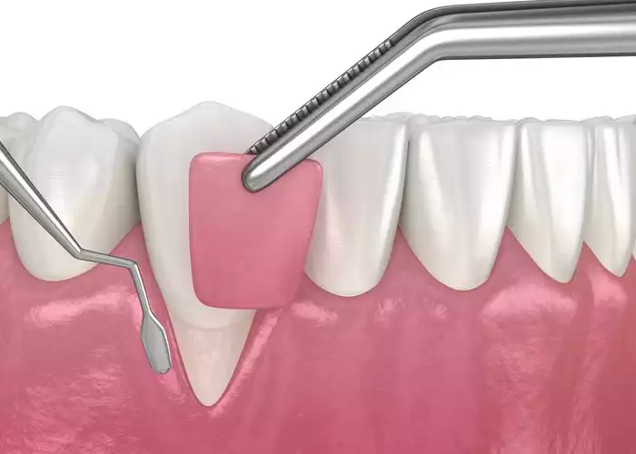 جراحی افزایش طول تاج دندان در شهریار