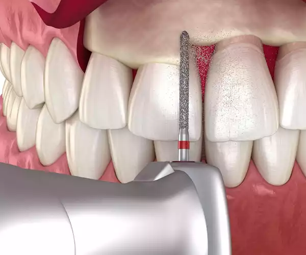 جراحی افزایش طول تاج دندان در شهریار