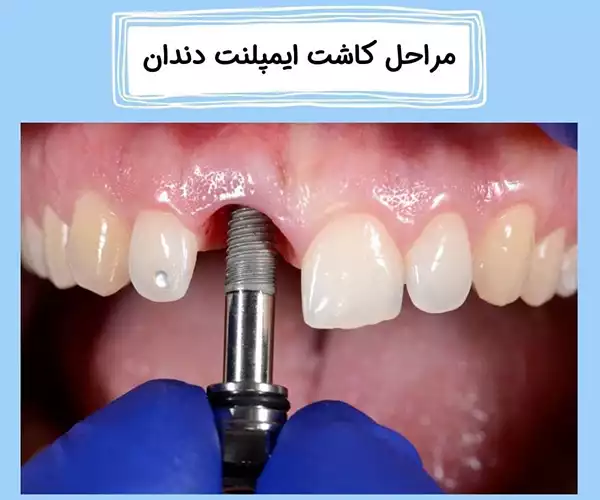 مراحل کاشت ایمپلنت دندان