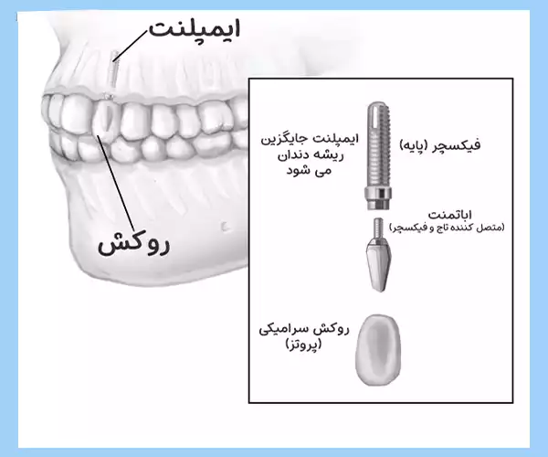 نصب پایه ایمپلنت دندان در استخوان فک در دندانپزشکی در شهریار