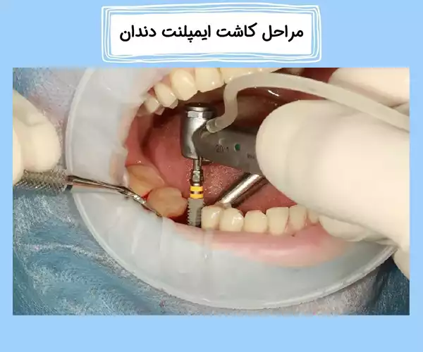 نصب پایه ایمپلنت دندان در استخوان فک