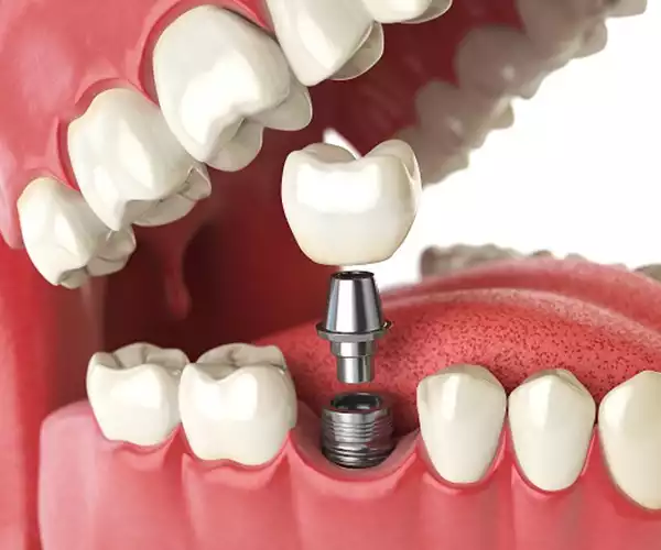 نصب پروتز ثابت روی دندان بیمار در کلینیک دندانپزشکی در شهریار