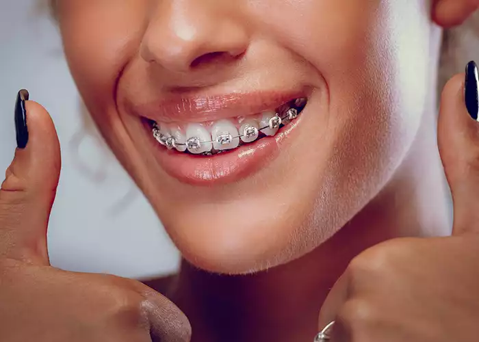 لبخند زن با ارتودنسی ثابت و رضایت از انجام ارتودنسی