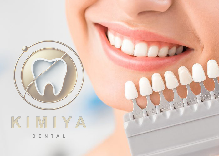 بلیچینگ دندان در دندانپزشکی کیمیا در شهریار
