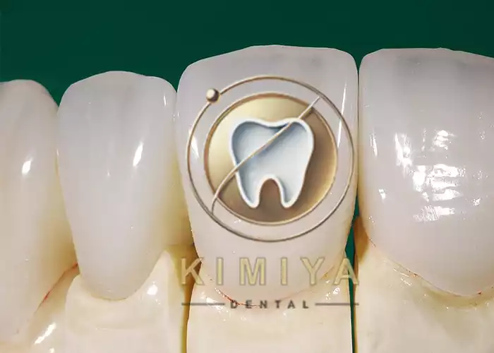 مزایای روکش تمام سرامیکی در کلینیک دندانپزشکی کیمیا در شهریار