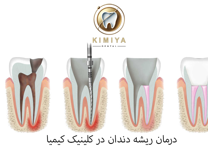 درمان ریشه دندان در کلینیک دندانپزشکی کیمیا در شهریار