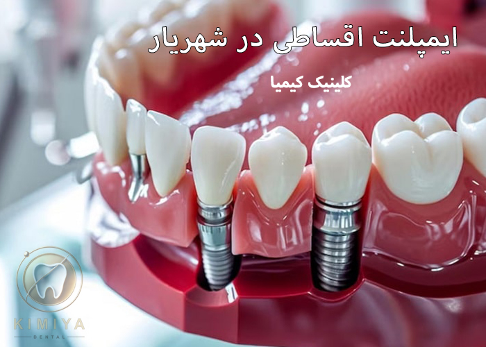 ایمپلنت اقساطی در شهریار در کلینیک دندانپزشکی کیمیا