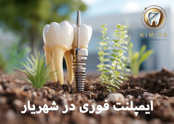 ایمپلنت فوری در شهریار در کلینیک کیمیا