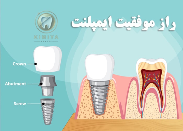مراقبت های بعد از ایمپلنت در کلینیک دندانپزشکی کیمیا