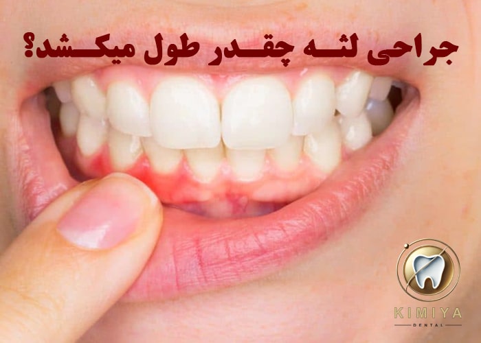 جراحی لثه چقدر طول میکشد؟مراحل کامل جراحی لثه در کلینیک دندانپزشکی کیمیا شهریار