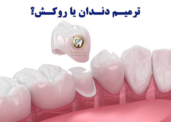 انتخاب ترمیم دندان یا روکش