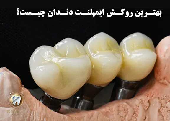 بهترین روکش ایمپلنت دندان در شهریار