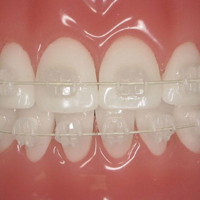براکت سرامیکی (Ceramic Brackets)