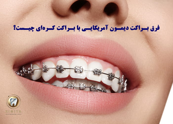 فرق براکت دیمون آمریکایی با براکت کرهای چیست؟