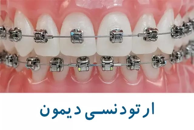 براکت دایمون