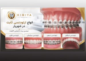 انواع ارتودنسی ثابت در شهریار در کلینیک دندانپزشکی کیمیا در شهریار