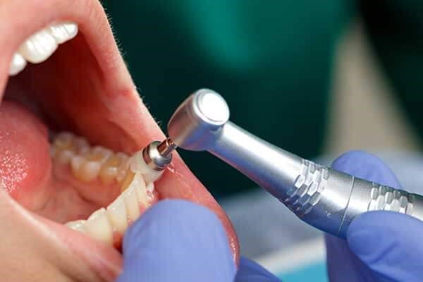 جرم گیری با دستگاه اولتراسونیک چگونه انجام می‌شود؟