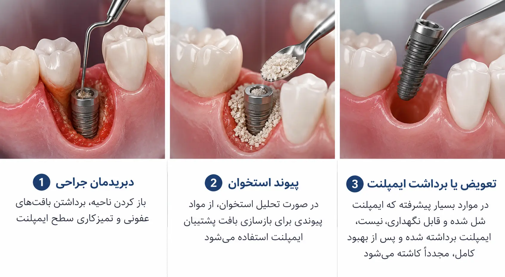 جراحی عفونت ایمپلنت دندان