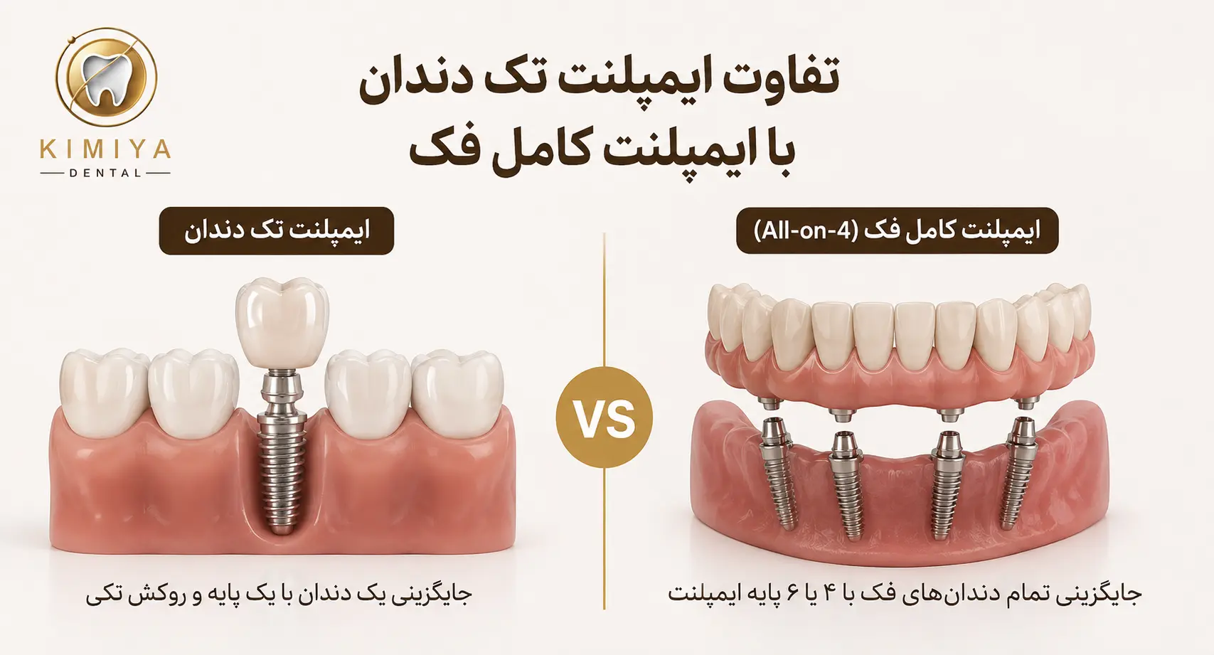 تفاوت ایمپلنت تک دندان با ایمپلنت کامل فک