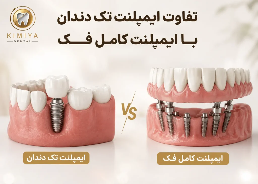 تفاوت ایمپلنت تک دندان با ایمپلنت کامل فک